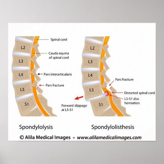 Poster Spondylolyse et spondylolisthèse, étiquetés (Devant)