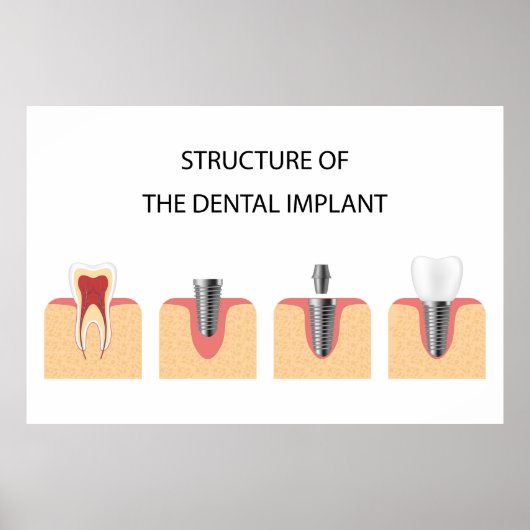 Poster Structure de l'implant dentaire (Devant)