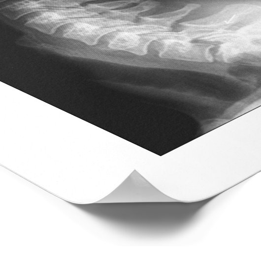 Poster Subluxation Espagnole Cervical Spinal Degeneration (Coin)