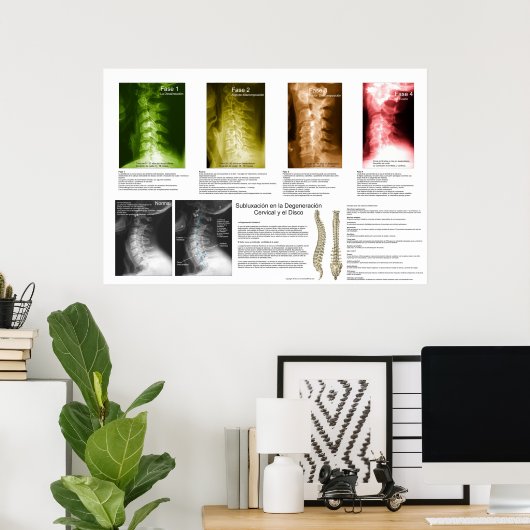 Poster Subluxation Espagnole Cervical Spinal Degeneration (Bureau à domicile)