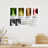 Poster Subluxation Espagnole Cervical Spinal Degeneration (Cuisine)