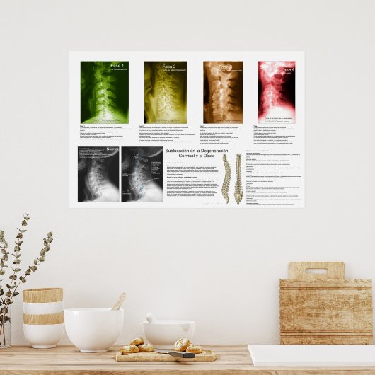 Poster Subluxation Espagnole Cervical Spinal Degeneration (Cuisine)