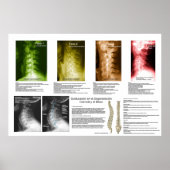 Poster Subluxation Espagnole Cervical Spinal Degeneration (Devant)