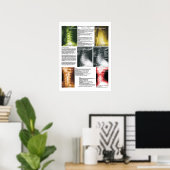 Poster Subluxation Espagnole Cervical Spinal Degeneration (Bureau à domicile)