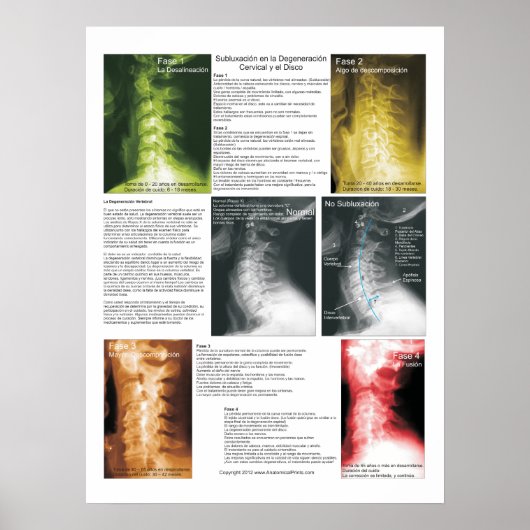 Poster Subluxation Espagnole Cervical Spinal Degeneration (Devant)