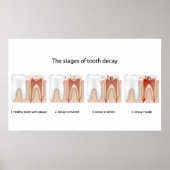 Poster sur la carie dentaire (Devant)