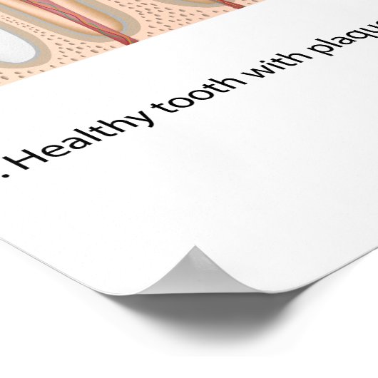 Poster sur la carie dentaire (Coin)