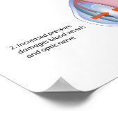 Poster sur la maladie des yeux Glaucome (Coin)