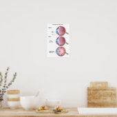 Poster sur la maladie des yeux Glaucome (Cuisine)