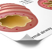 Poster sur la maladie pulmonaire Asthma (Coin)