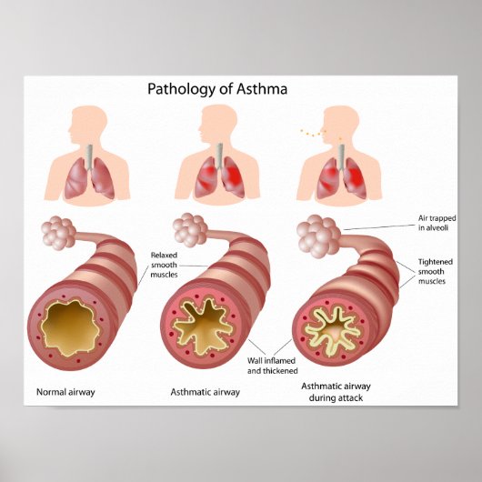 Poster sur la maladie pulmonaire Asthma (Devant)
