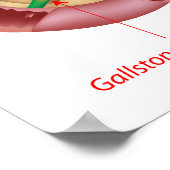 Poster sur la pancréatite aiguë (Coin)