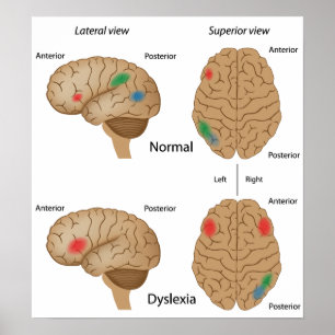 Poster sur l'activité cérébrale de la dyslexie