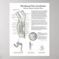 Poster sur le syndrome de douleur myofascial