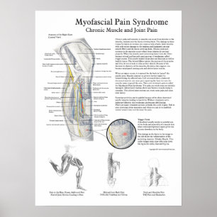 Poster sur le syndrome de douleur myofascial