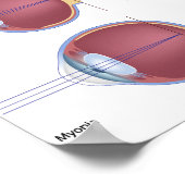 Poster sur les défauts oculaires courants (Coin)