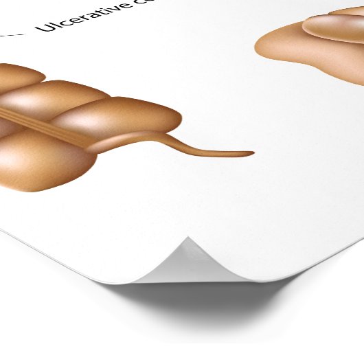 Poster sur les pathologies du côon (Coin)