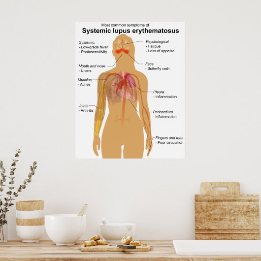 Poster Symptom Graphique du lupus érythémateux systémique (Cuisine)