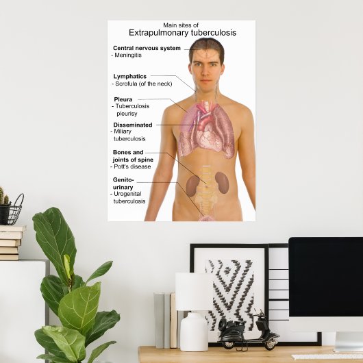 Poster Symptômes principaux de la tuberculose extrapulmon (Bureau à domicile)
