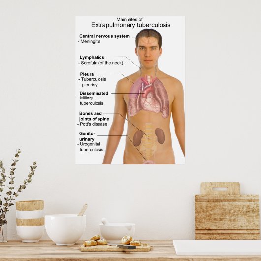 Poster Symptômes principaux de la tuberculose extrapulmon (Cuisine)