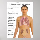 Poster Symptômes principaux de la tuberculose extrapulmon (Devant)