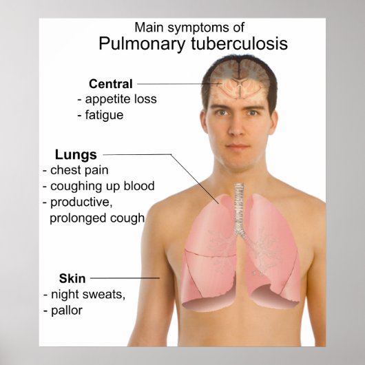 Poster Symptômes principaux de la tuberculose pulmonaire (Devant)