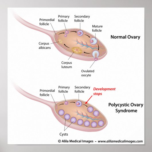 Poster Syndrome de l'ovaire polykystique, diagramme étiqu (Devant)