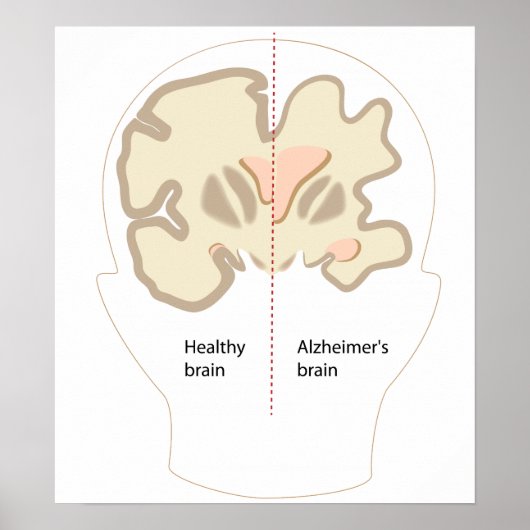 Poster van Alzheimer (Voorkant)