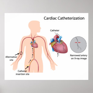 Poster voor cardiale catheterisatie
