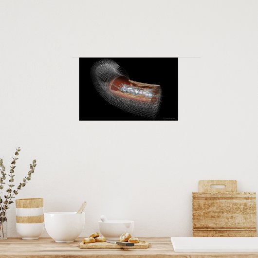Poster Vue d'un ballon angioplatique dans une artère (Cuisine)