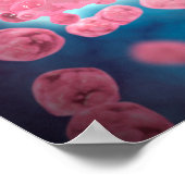 Poster Vue Microscopique D'Un Groupe De Cellules Leucémiq (Coin)