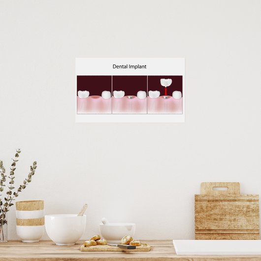 Procédure d'implant dentaire Poster (Cuisine)