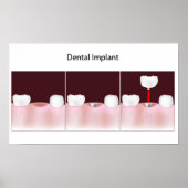 Procédure d'implant dentaire Poster (Devant)