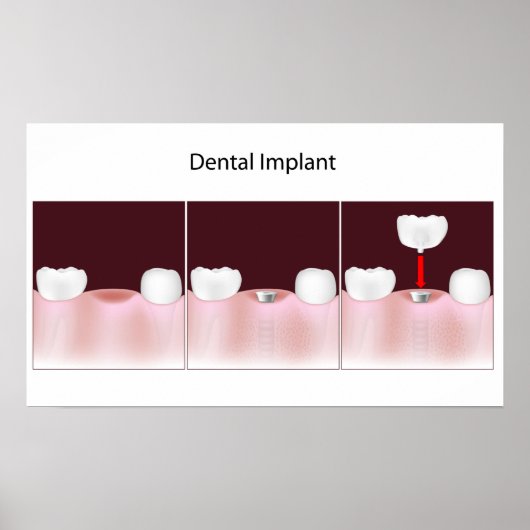 Procédure d'implant dentaire Poster (Devant)