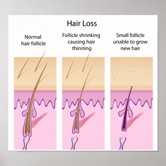 Processus de perte de cheveux Poster (Devant)
