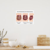 Proctocolectomie totale avec affiche d'iléostomie  (Cuisine)