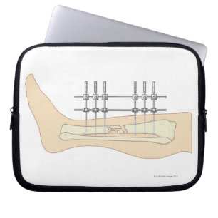 Protection Pour Ordinateur Portable Fixator externe