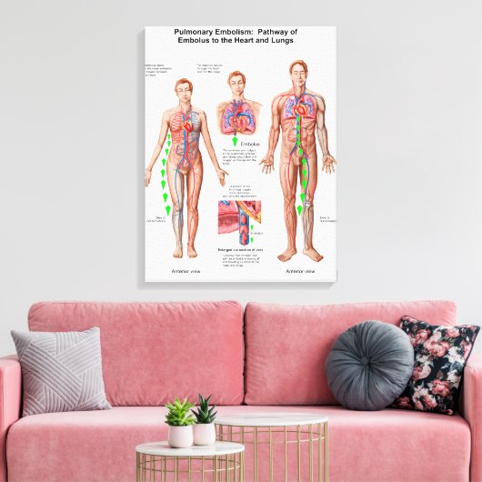 Pulmonaire embolie, route van embolus canvas afdruk (Insitu (Woonkamer))