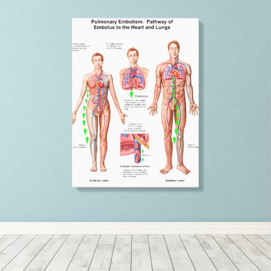 Pulmonaire embolie, route van embolus canvas afdruk (Insitu (Houten vloer))