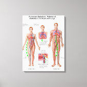 Pulmonaire embolie, route van embolus canvas afdruk (Voorkant)