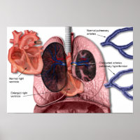 Pulmonale hypertensie poster