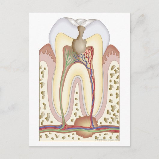 Pulp- en wortelabscess briefkaart (Voorkant)