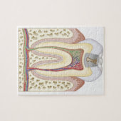 Puzzle Illustration de la carie dentaire (Horizontal)