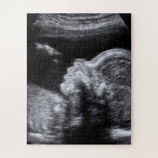 Puzzle Photo Ultrasound (Vertical)