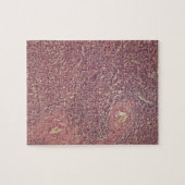 Puzzle Rate humaine avec la leucose myélogène chronique (Horizontal)