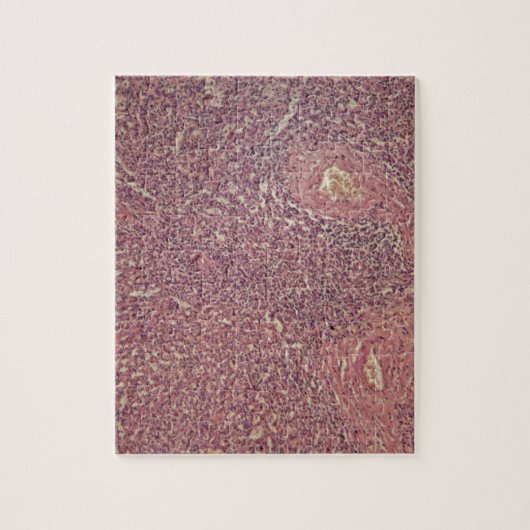 Puzzle Rate humaine avec la leucose myélogène chronique (Vertical)