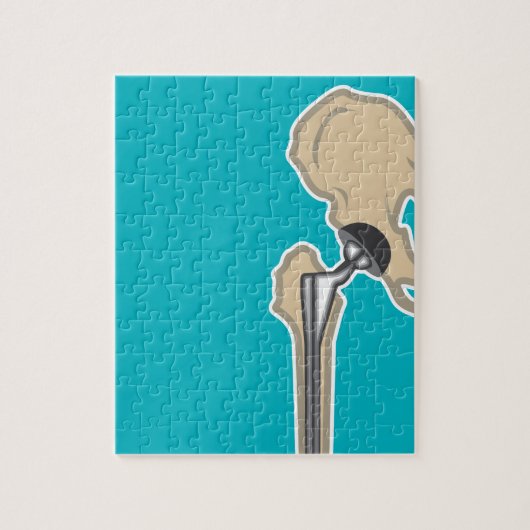 Puzzle Remplacement d'articulation de la hanche (Vertical)