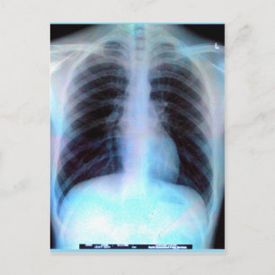 Ribcage Xray Skeleton Briefkaart