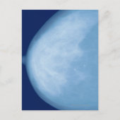 Röntgenfoto van borst van vrouwen, uitzicht aan de briefkaart (Voorkant)