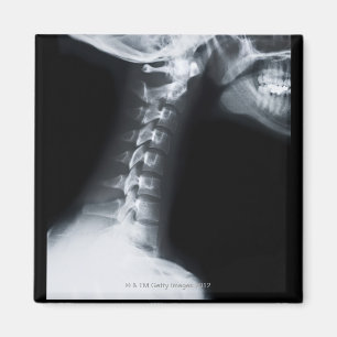 Röntgenfoto van halswervels inclusief onderkaak magneet